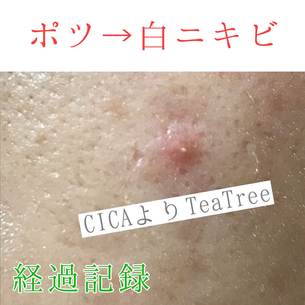 ティーツリーケア ソリューション エッセンシャルマスクEX/MEDIHEAL/シートマスク・パックを使ったクチコミ（1枚目）