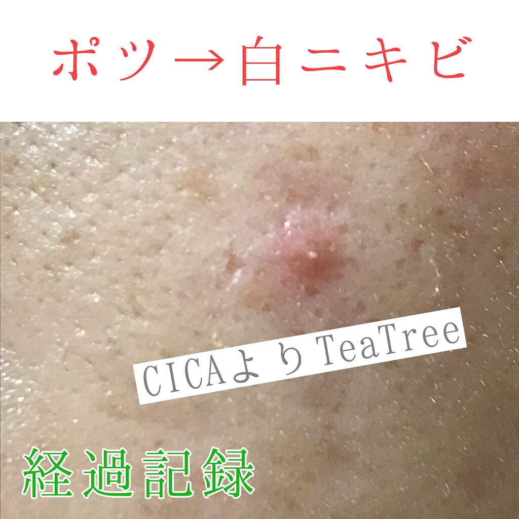 プロCICA クリアスポットパッチ/VT/その他スキンケアを使ったクチコミ(1枚目)