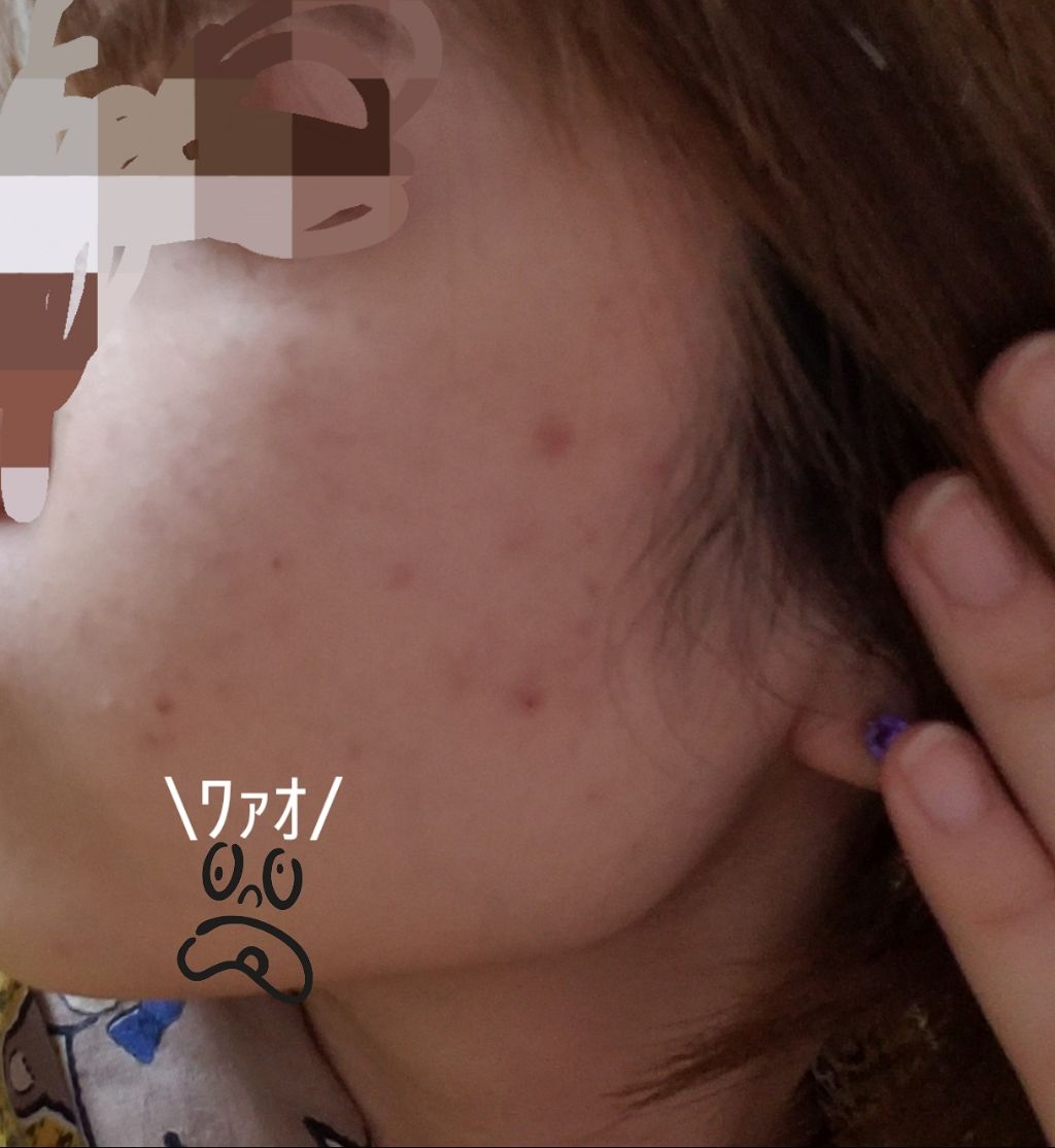 まっぴょん on LIPS 「語らせて欲しい。(愚痴みたいなもんやないか)ま〜た肌荒れしたよ..」(2枚目)