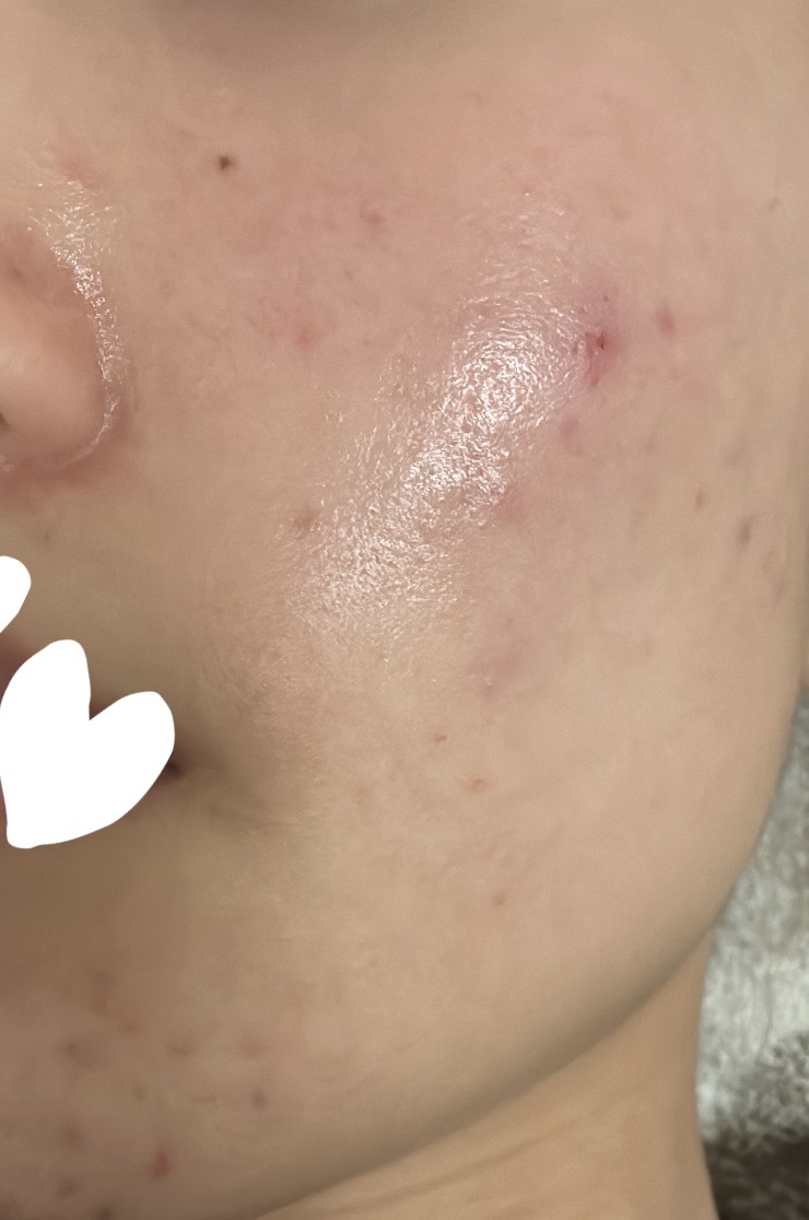 潤浸保湿 化粧水 II しっとり/キュレル/化粧水を使ったクチコミ（2枚目）