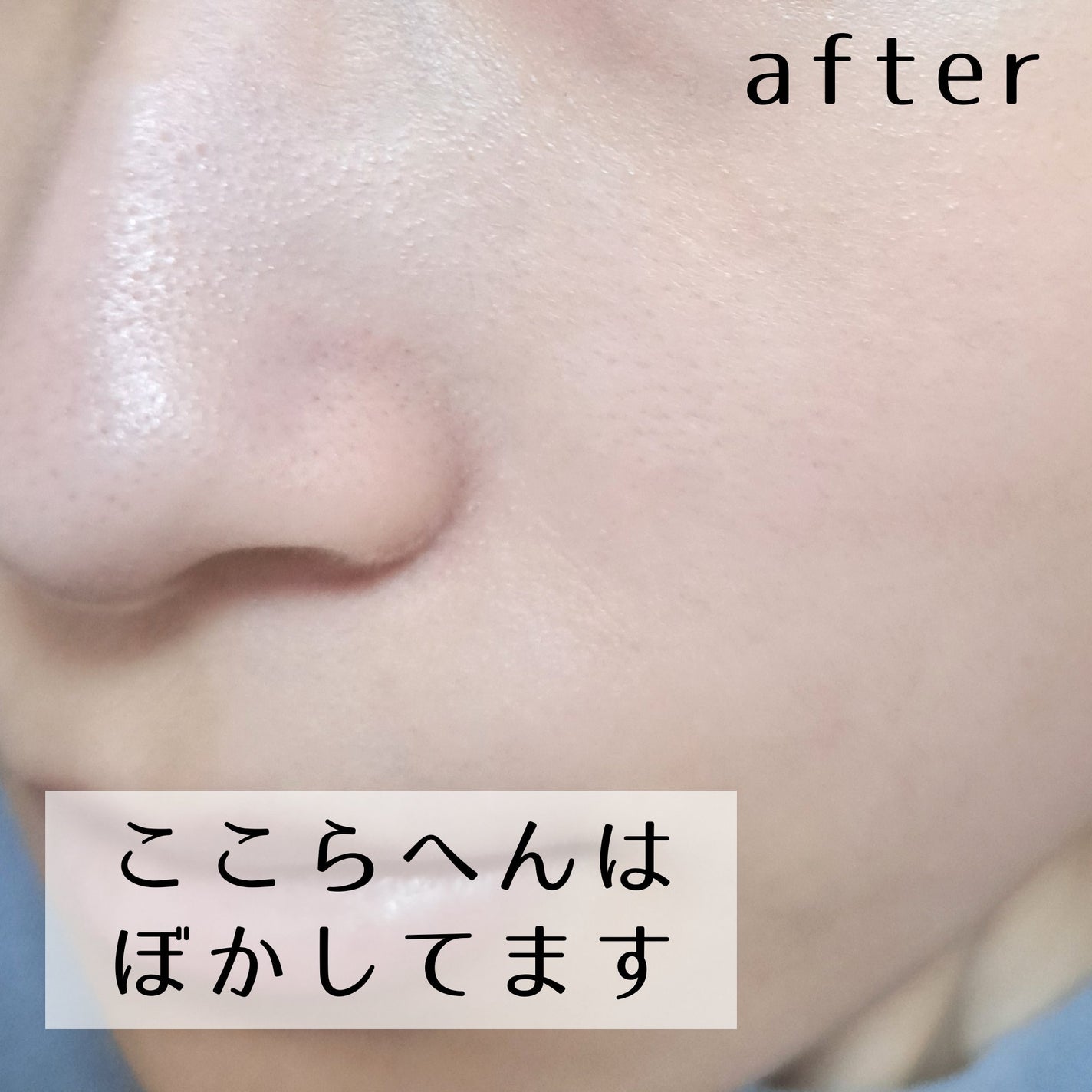 ダーマセプトRX AZAセラム/ダーマセプトRX/美容液を使ったクチコミ(4枚目)