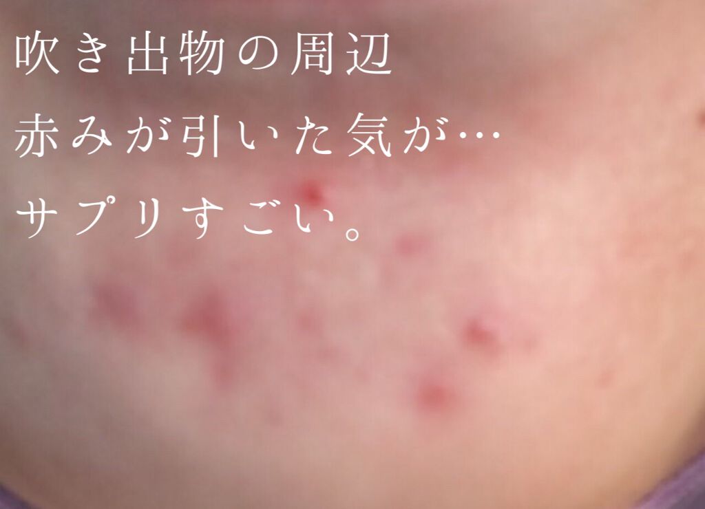 DHC はとむぎエキス/DHC/健康サプリメントを使ったクチコミ（2枚目）