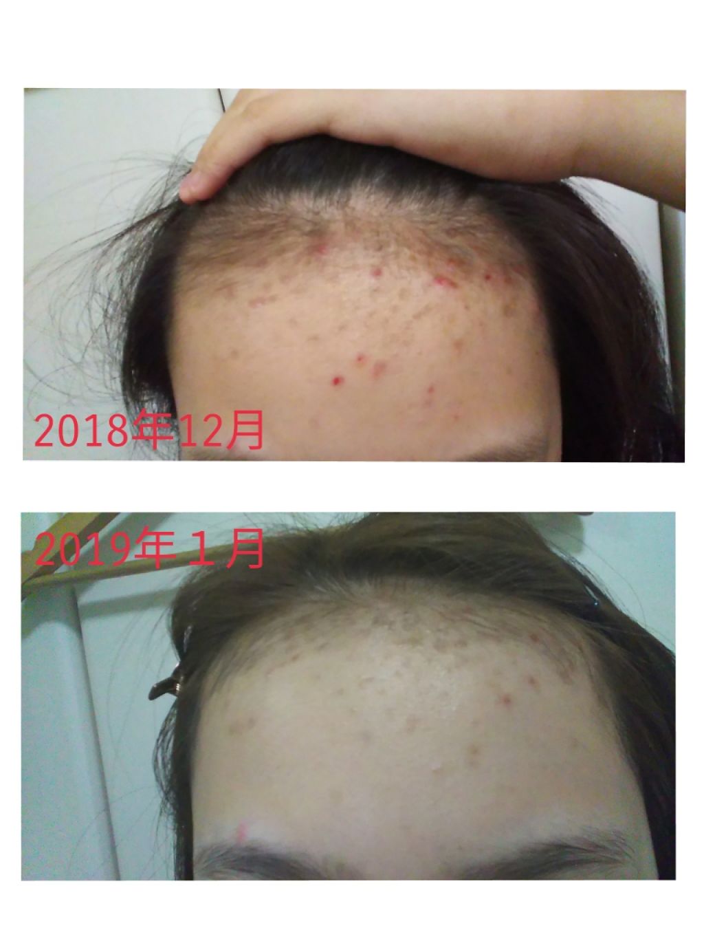 バイオイル/バイオイル/フェイスオイルを使ったクチコミ（2枚目）