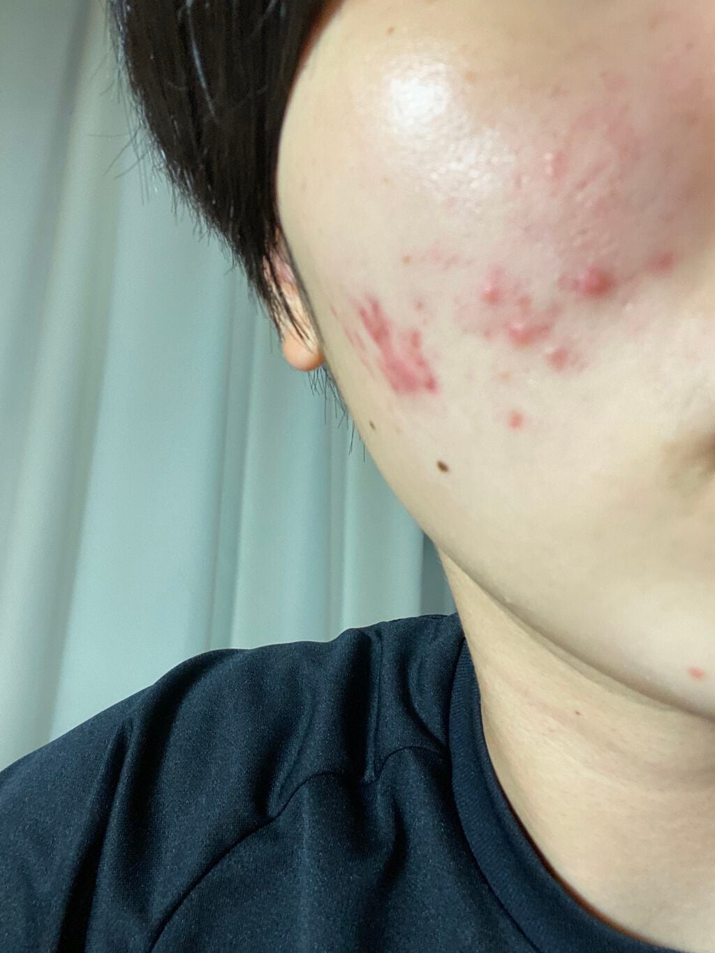 のの on LIPS 「お久しぶりです。一向にニキビが良くならないです。何かいいスキン..」(2枚目)