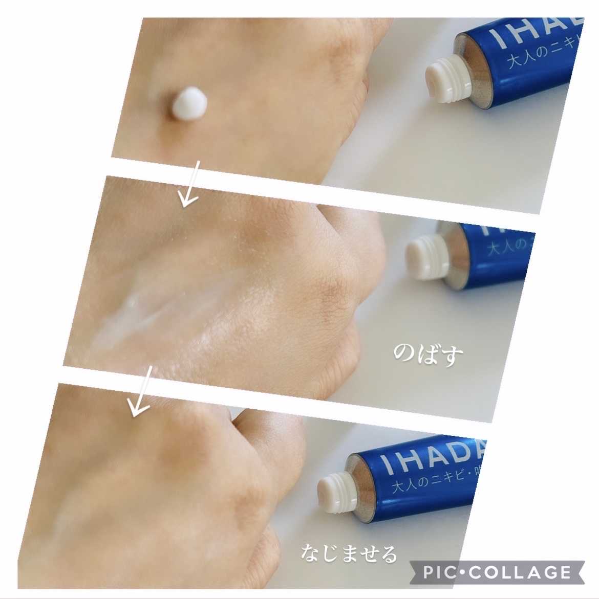 アクネキュアクリーム(医薬品)/IHADA/その他を使ったクチコミ（3枚目）