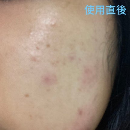 P.D.F A.Cドレッシングアンプルマスク EX/MEDIHEAL/シートマスク・パックを使ったクチコミ(5枚目)