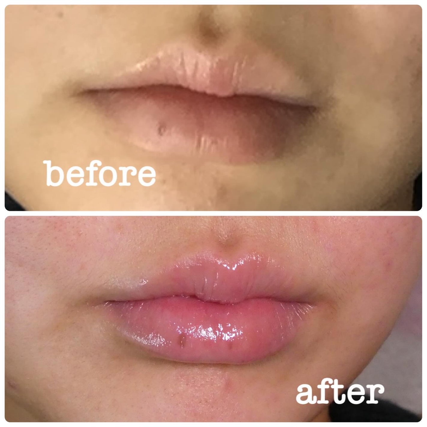 Q+Me ボムショットリッププランパー+/AGARISM/リッププランパーを使ったクチコミ(6枚目)