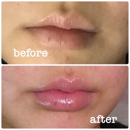 Q+Me ボムショットリッププランパー+/AGARISM/リッププランパーを使ったクチコミ(6枚目)