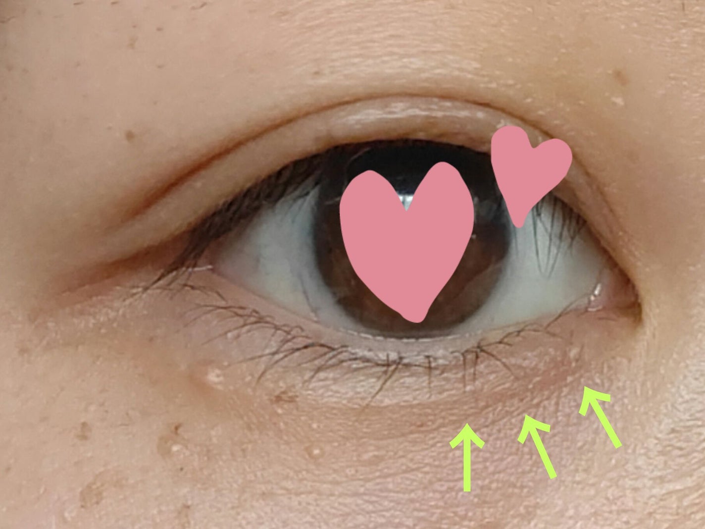 ããã³ ã¢ããã¢ã€ã¹ã ãšã€ãžã³ã°ã±ã¢ ãã€ã¯ãªãŒã UV/ããã³/æ¥çŒãæ¢ãã¯ãªãŒã ã䜿ã£ãã¯ãã³ãïŒ3æç®ïŒ