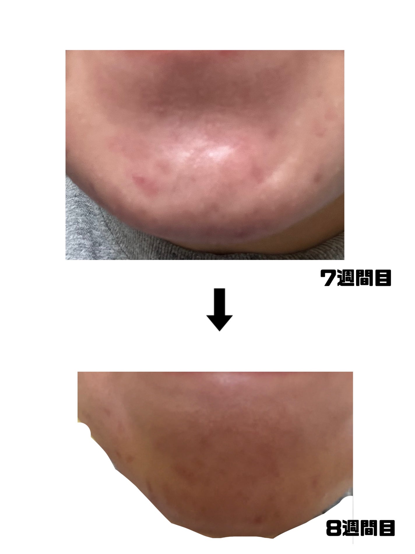 みこ on LIPS 「【ニキビ治療経過記録】閲覧注意です!エピデュオゲルやその他もろ..」(4枚目)