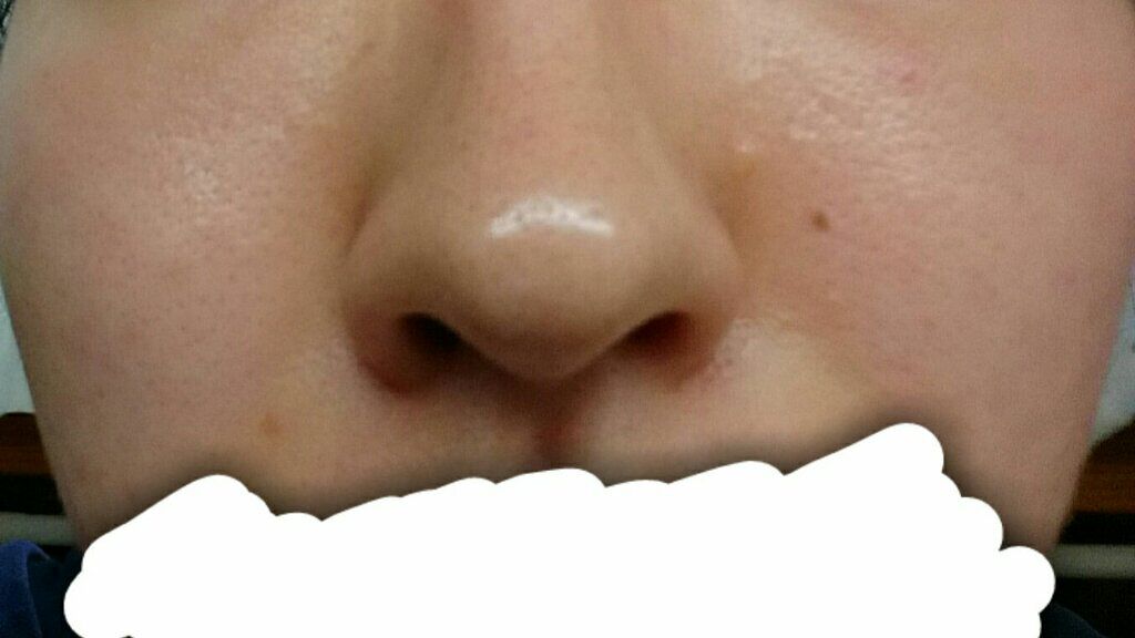 ベピオゲル/マルホ株式会社/その他を使ったクチコミ（3枚目）