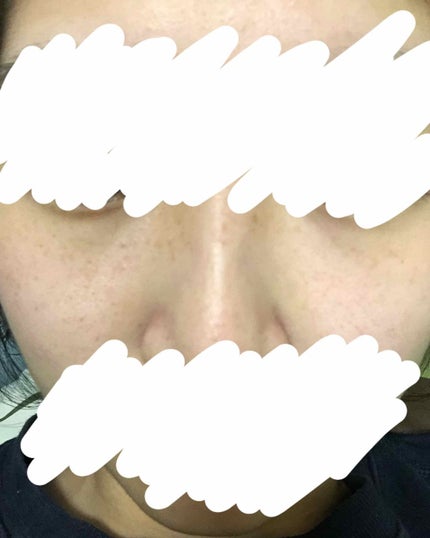 メラノCC 薬用しみ集中対策液(旧)/メラノCC/美容液を使ったクチコミ(2枚目)