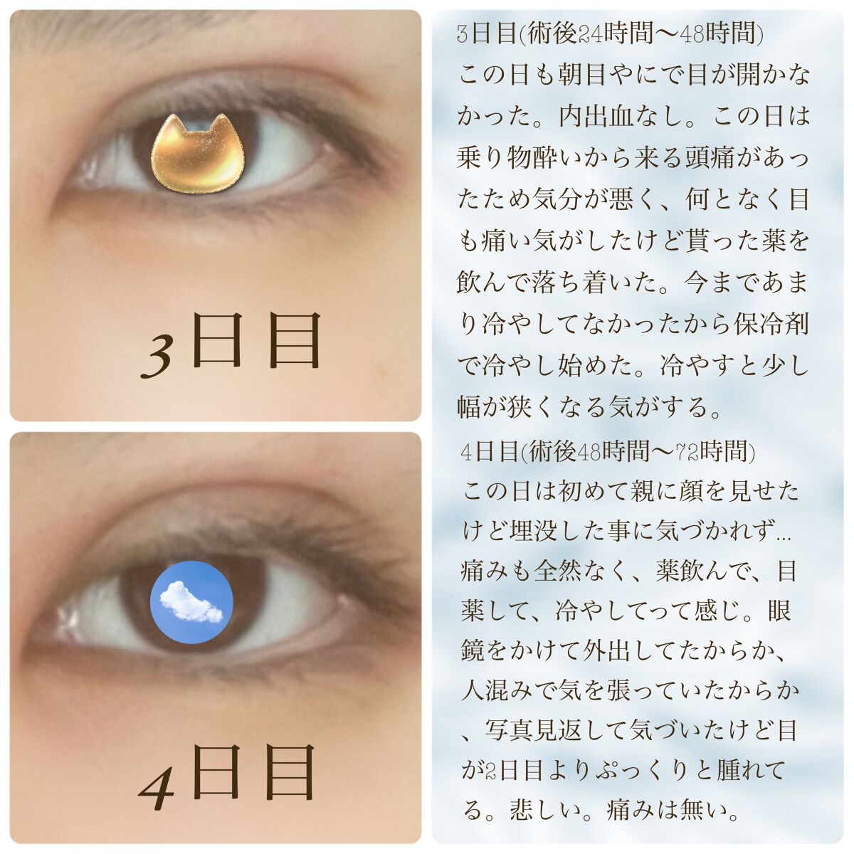 ◢͟│⁴⁶のおたく on LIPS 「⚠️目の写真がいっぱいあります⚠️湘南美容外科で埋没の整形をし..」(5枚目)