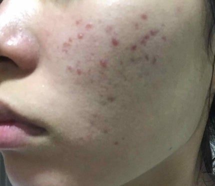 薬用 しみ 集中対策 美容液/メラノCC/美容液を使ったクチコミ(1枚目)