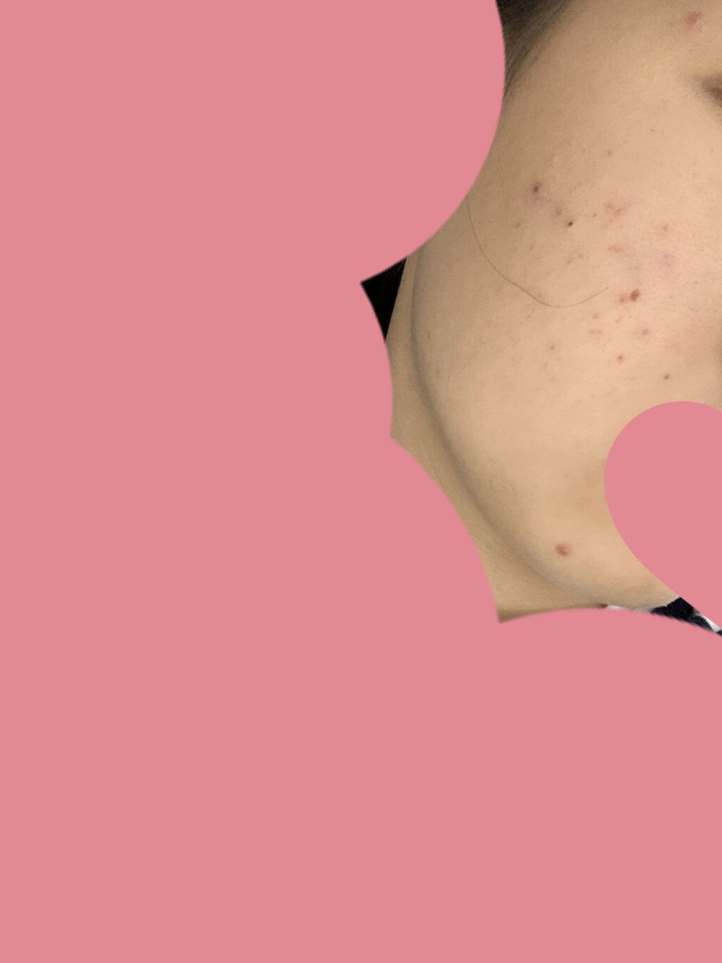 ペアアクネクリームW(医薬品)/ペア/その他を使ったクチコミ（3枚目）