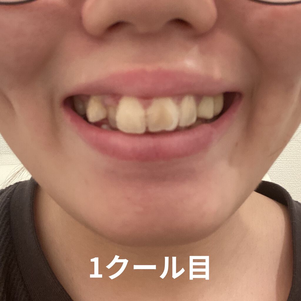 マウスピース矯正/その他を使ったクチコミ（2枚目）