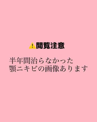 他の方からしたらまだまだ綺麗じゃないし跡もあるし、なんなら最近出来た吹き出物もありますが私としては今なら晒せる肌になれたと思っています。

前回、自分語りをがっつりしたのでスキンケアだけさっくりと。

