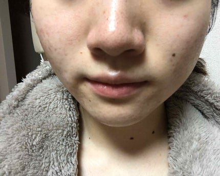 マンスリースキンケアプログラム(旧)/APEX/スキンケアキットを使ったクチコミ(2枚目)