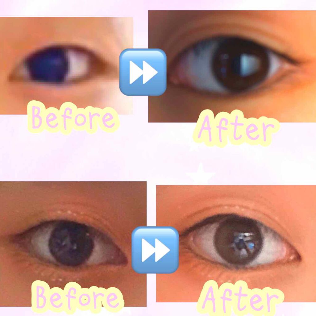 のびーるアイテープ（絆創膏タイプ、レギュラー）/DAISO/二重まぶた用アイテムを使ったクチコミ（2枚目）