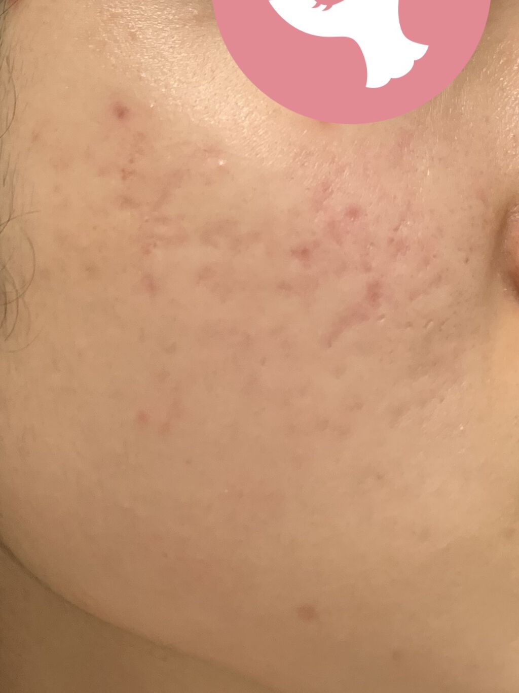 薬用パウダー化粧水/メンソレータム アクネス/化粧水を使ったクチコミ（2枚目）