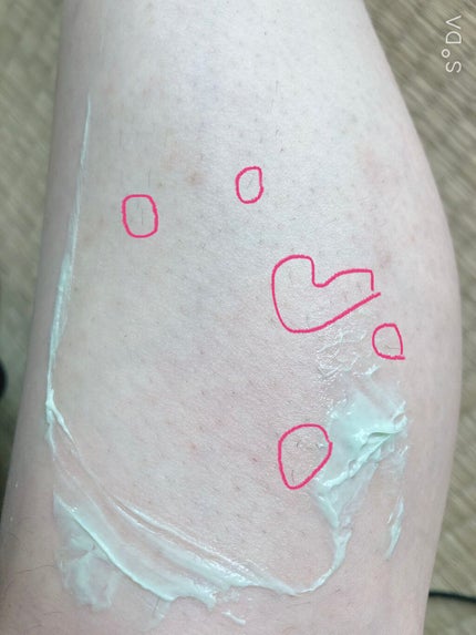 リムーバーフラペ/スージースタンド/除毛クリームを使ったクチコミ(5枚目)