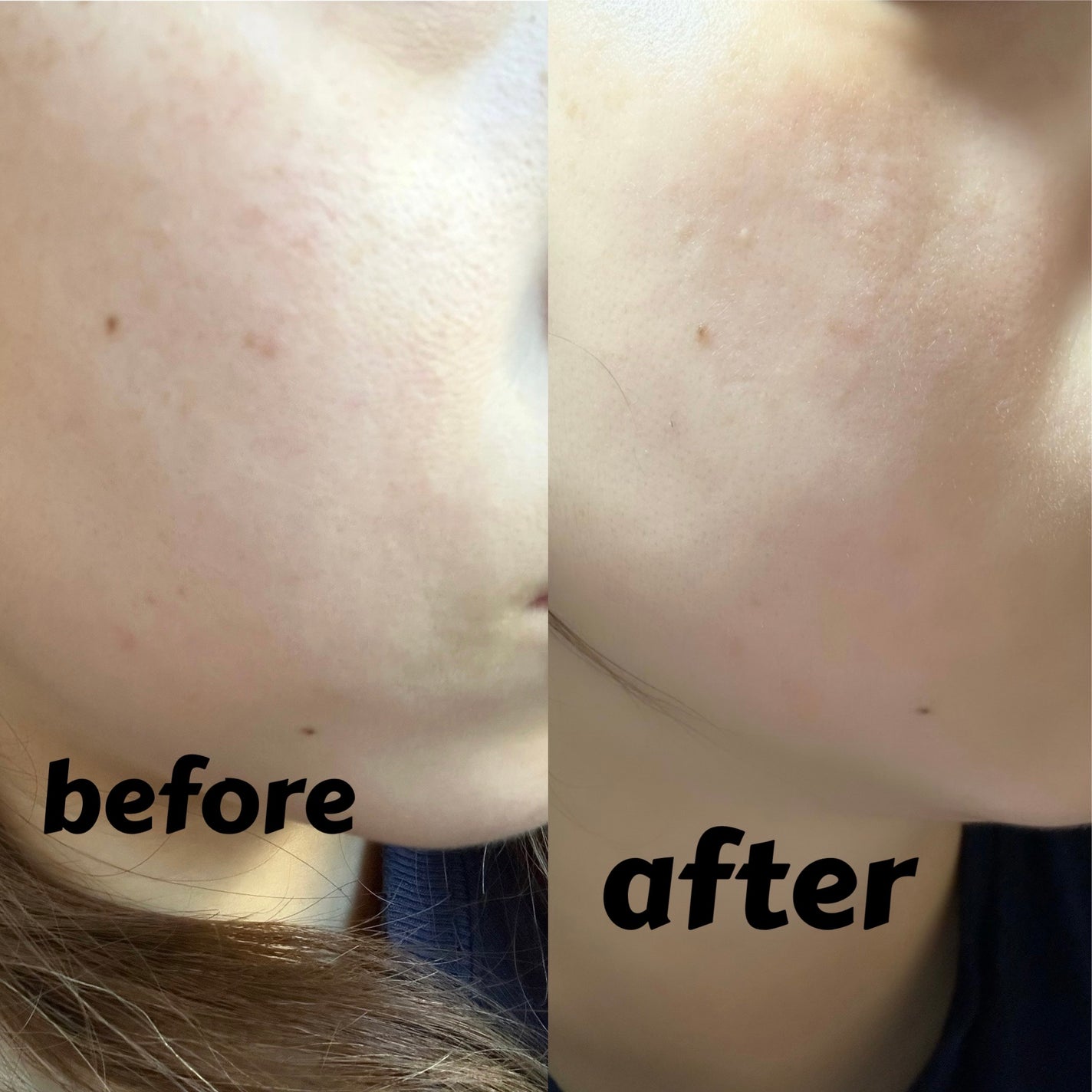 リードルショット300/VT/美容液を使ったクチコミ(2枚目)