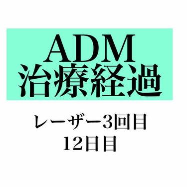 【ADM治療経過レーザー3回目12日目】

レーザー3回目を当て、12日経ちました。


［画像2枚目］

レーザー2回目よりも赤みが消えるの早くなったような気が。

引用記事と比較してもらえると分かり