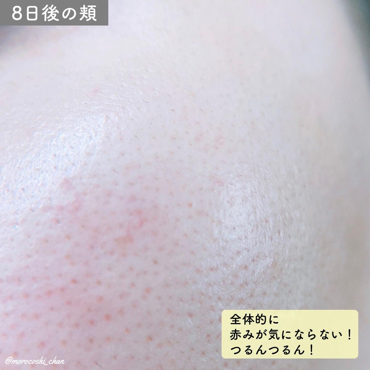 ダーマスキンピーリング/BQCELL/その他キットセットを使ったクチコミ(5枚目)