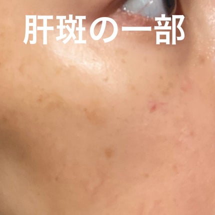 トランシーノII (医薬品)/トランシーノ/その他を使ったクチコミ(3枚目)