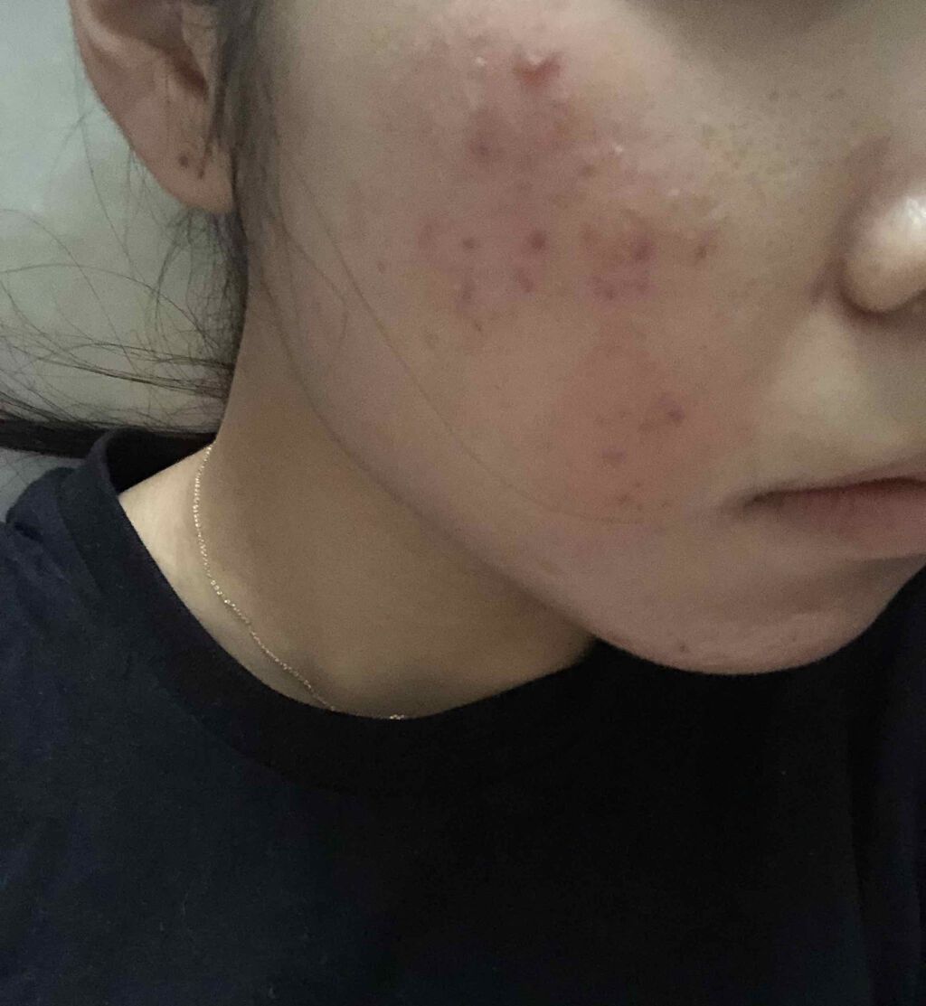 orange_perfume_2opm on LIPS 「今日でちょうど2週間経過!良くなってるのかなあ、、、🙍🏼泣赤み..」(2枚目)