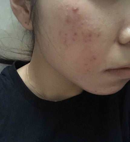 エピデュオゲル/マルホ株式会社/その他を使ったクチコミ(2枚目)