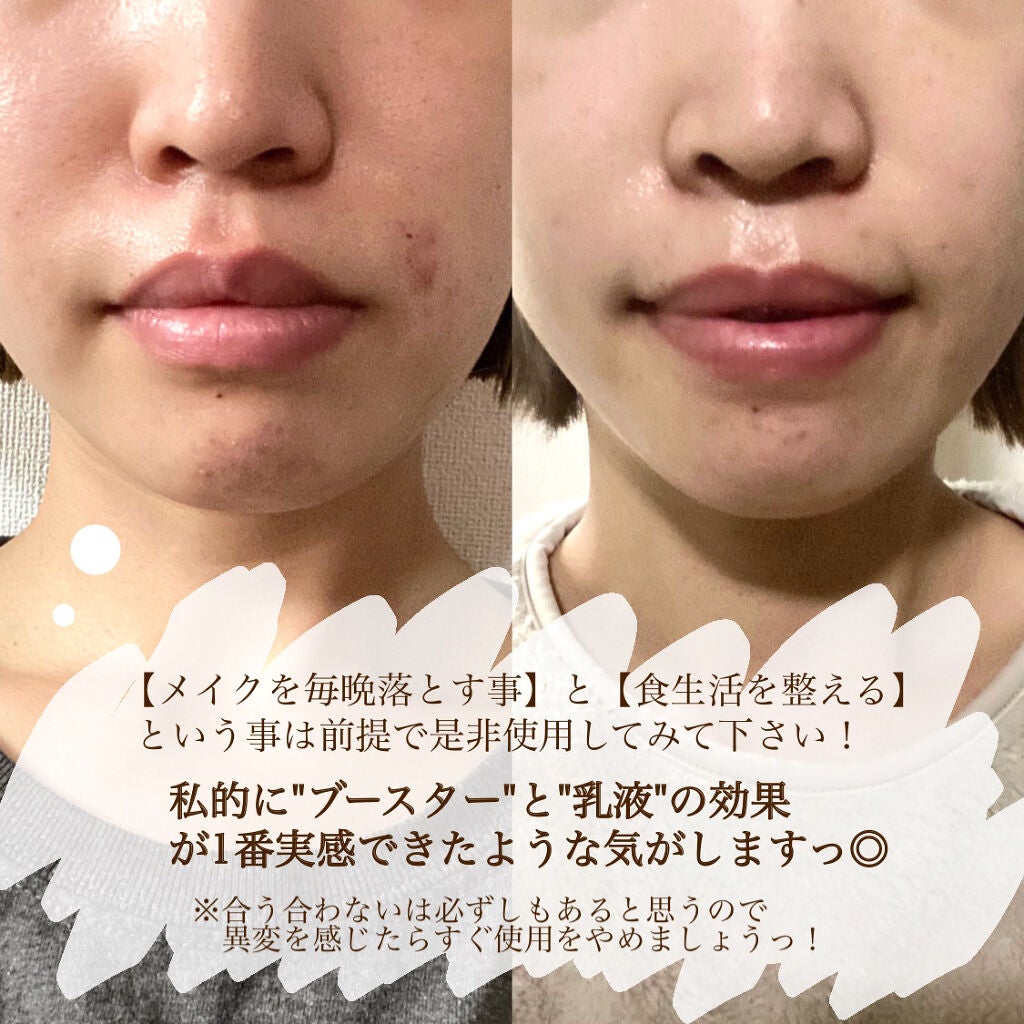 シミ・ソバカス予防ケア 乳液/キュレル/乳液を使ったクチコミ(6枚目)