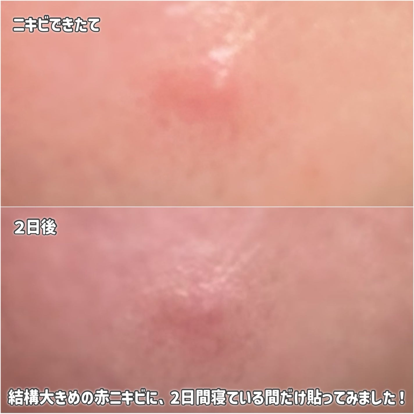 ACマグネシウムパッチ ミニ/スノーツープラス/にきびパッチを使ったクチコミ(4枚目)