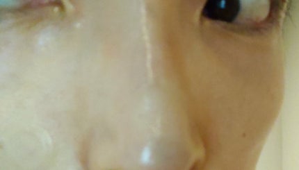 エーキュアショットスポットパッチ/obsero/にきびパッチを使ったクチコミ(2枚目)