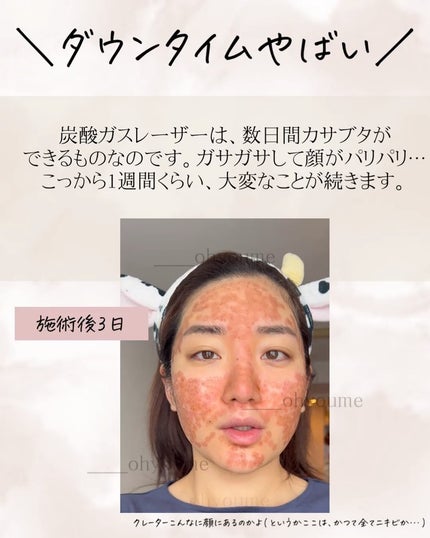 おゆみ|ニキビ・ニキビ跡ケア on LIPS 「@______ohyoume他の投稿はこちらから【サブシジョン..」(4枚目)