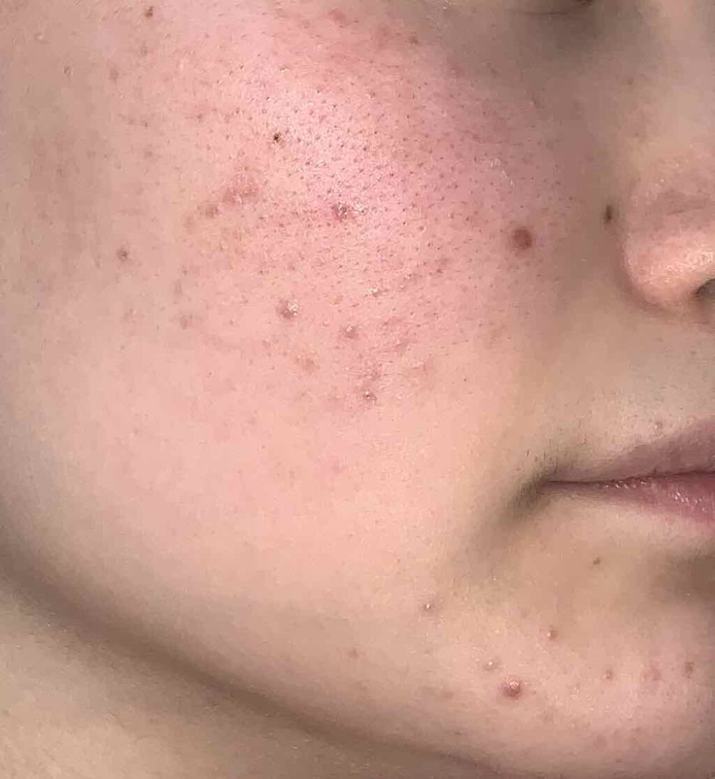 ドクダミ 77 スージングトナー/Anua/化粧水を使ったクチコミ(2枚目)