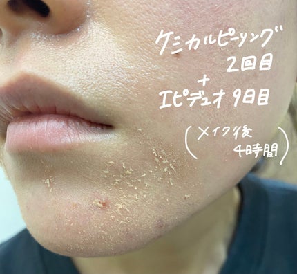 スキンピールバー ティートゥリー/サンソリット/洗顔石鹸を使ったクチコミ(7枚目)