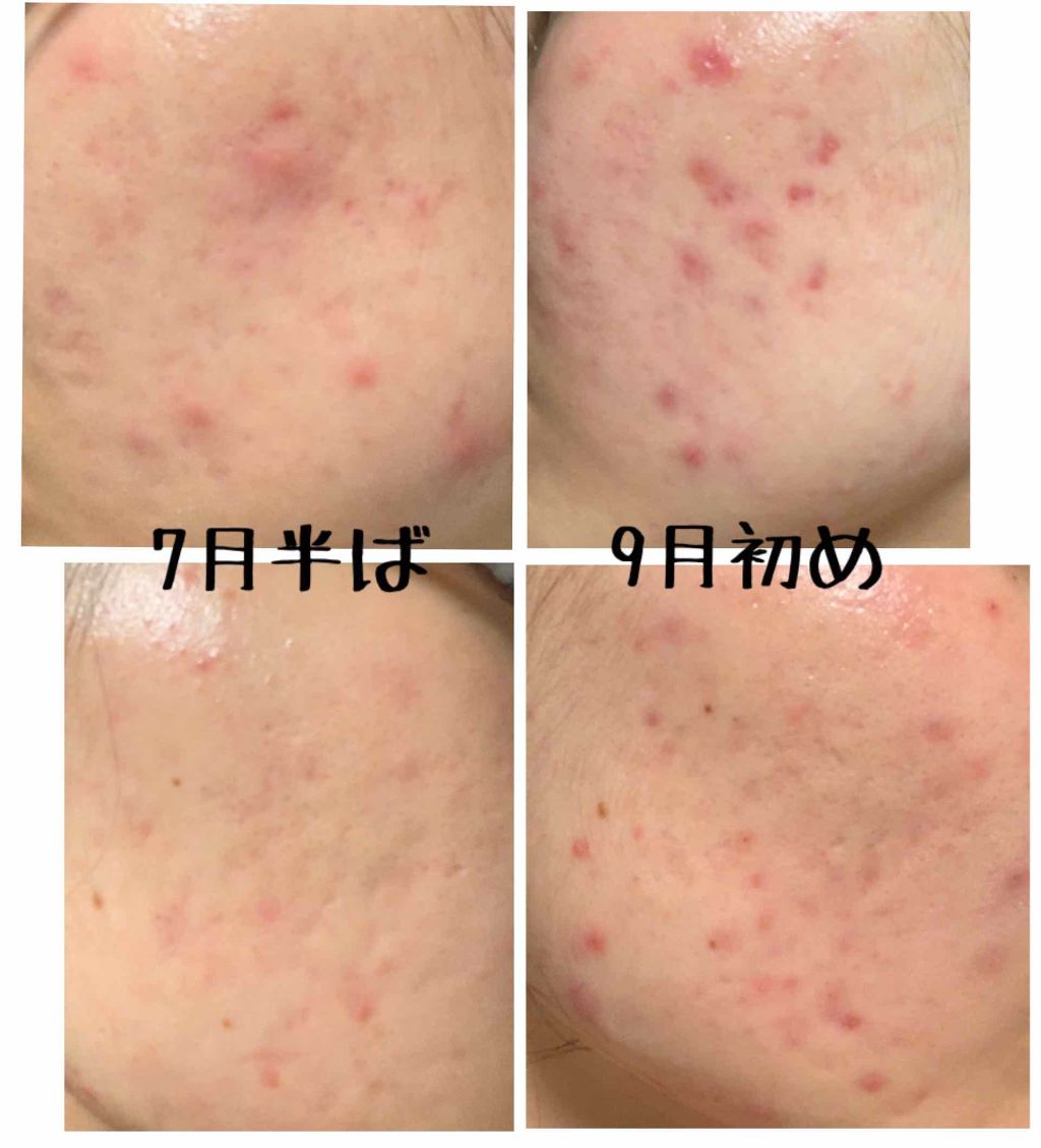 まな on LIPS 「どうも。⚠️2枚目に汚い肌の写真があります、注意してください⚠..」(2枚目)