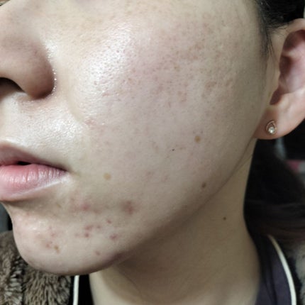 スキンピールバー ティートゥリー/サンソリット/洗顔石鹸を使ったクチコミ(2枚目)