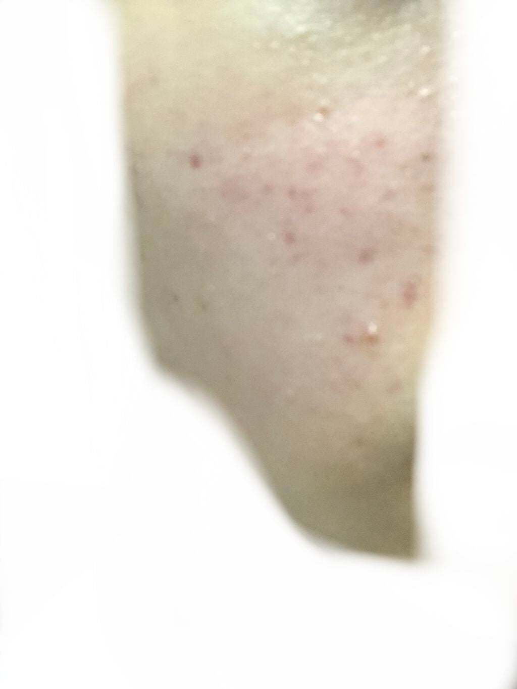 なな on LIPS 「みなさんこんにちは!肌断食をしたところちょくちょく治るところは..」(2枚目)