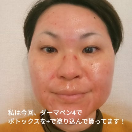 ビヨンセ奥二重向上委員長🥸LIPSパートナー🥳 on LIPS 「ダーマペン4をやってきたよ!!何種類か選べる薬剤から私はボトッ..」(6枚目)