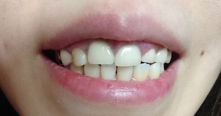 ホワイトニングペースト/Smile Cosmetique/歯磨き粉を使ったクチコミ(3枚目)