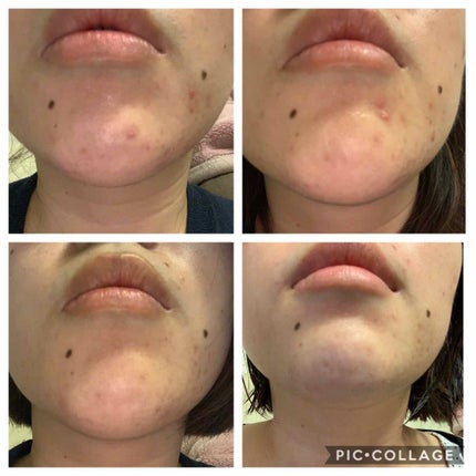 ペアアクネクリーンローション/ペア/化粧水を使ったクチコミ(3枚目)