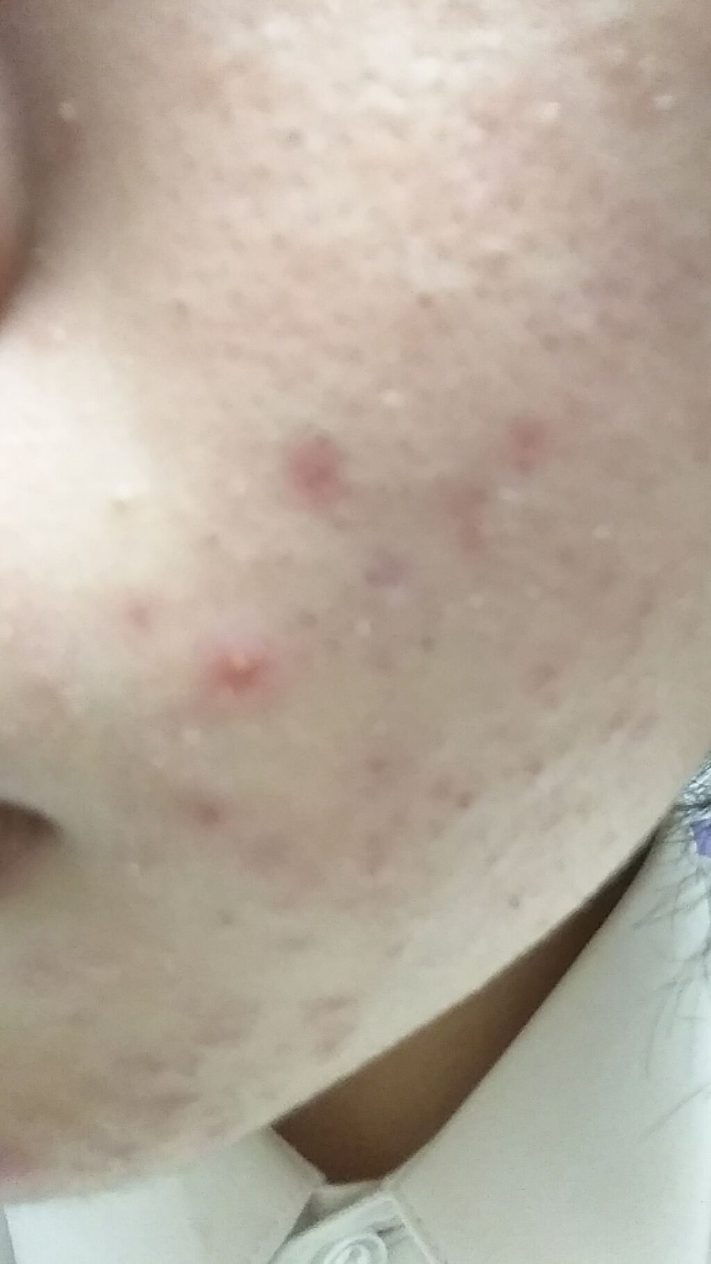 オードムーゲ 薬用ローション（ふきとり化粧水）/オードムーゲ/拭き取り化粧水を使ったクチコミ（1枚目）