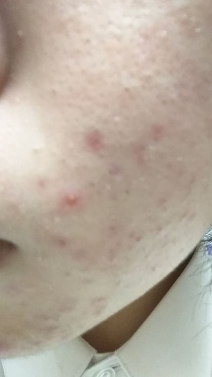 オードムーゲ 薬用ローション(ふきとり化粧水)/オードムーゲ/拭き取り化粧水を使ったクチコミ(1枚目)