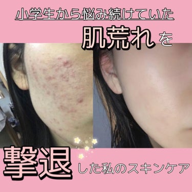 肌ラボ 白潤プレミアム薬用浸透美白化粧水のクチコミ「肌が綺麗になって人生が変わったスキンケア🍑







私は小学生6年生からニキビに悩まされ.....」（1枚目）