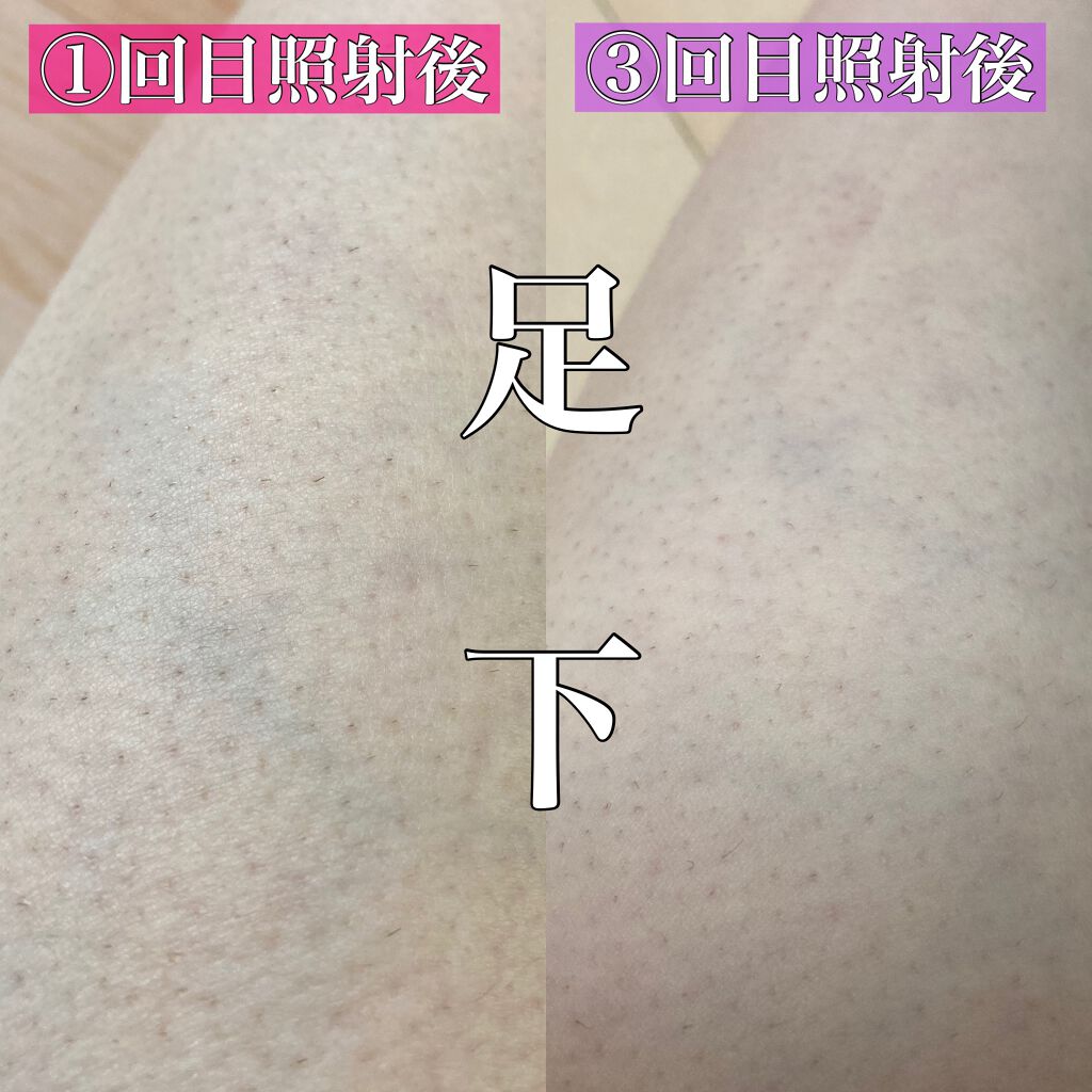 光美容器 光エステ ボディ&フェイス用 ハイパワー ゴールドES 光美容器 光エステ ボディ&フェイス用 ハイパワー ゴールドES