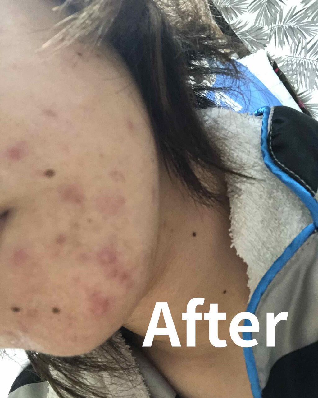 めぐぽん on LIPS 「ニキビがひどすぎて月曜日皮膚科行って貰ったお薬です!1週間塗っ..」(2枚目)