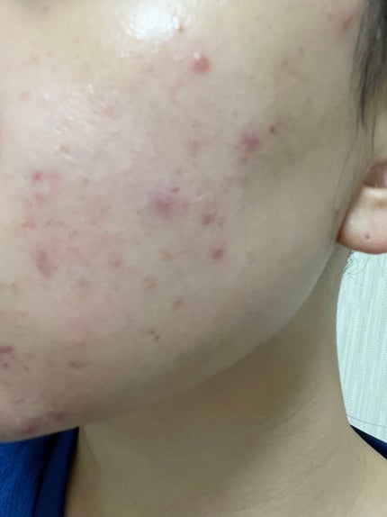 まままこ on LIPS 「ニキビゼロ肌を目指して〜8/20〜⚠️2枚目から肌画像ありスキ..」(2枚目)
