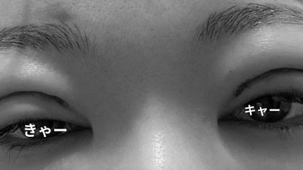 め@フォロバします on LIPS 「6/21追記二重全切開&脱脂の記録。2021年8月31日に受け..」(4枚目)